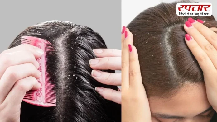 बार-बार हो रहा है डैंड्रफ, तो इन बातों को न करें नजरअंदाज