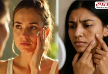 चेहरे पर पड़े चेचक के दाग से हैं परेशान, अब घर पर ही कर सकेंगी इसका इलाज