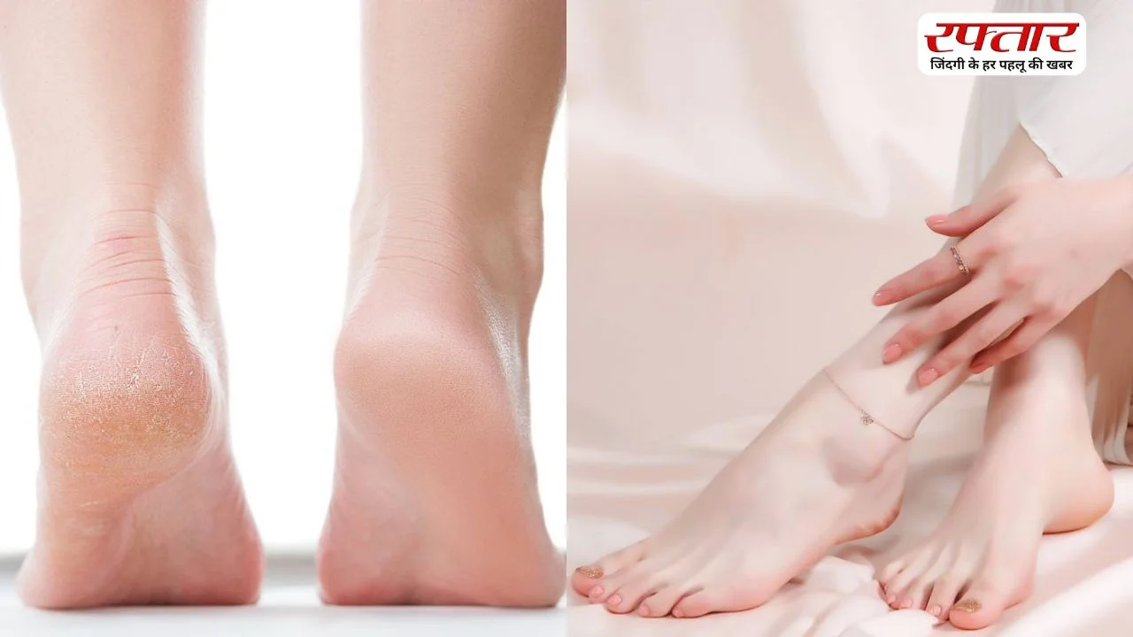 गर्मियों में फटी एड़ियों का इलाज, अपनाएं ये आसान घरेलू नुस्खे